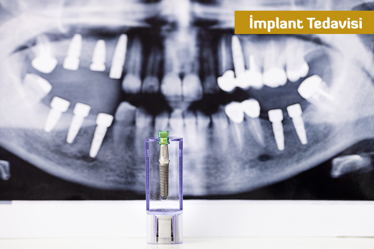 İmplant Tedavisi