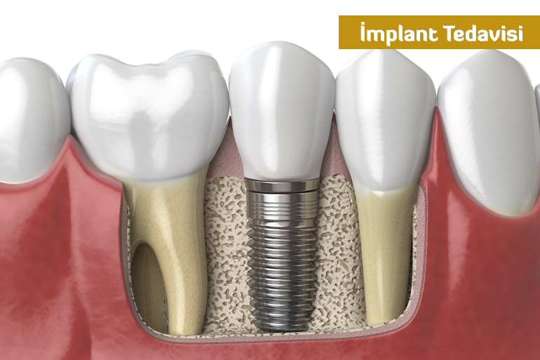 İmplant Tedavisi