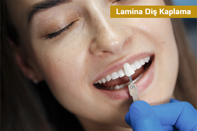 Lamina Diş Kaplama