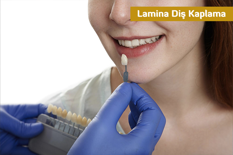 Lamina Diş Kaplama