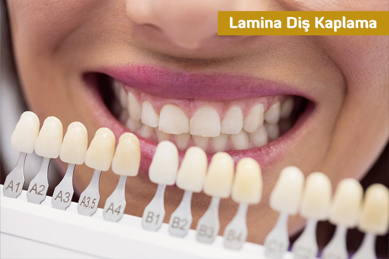 Lamina Diş Kaplama