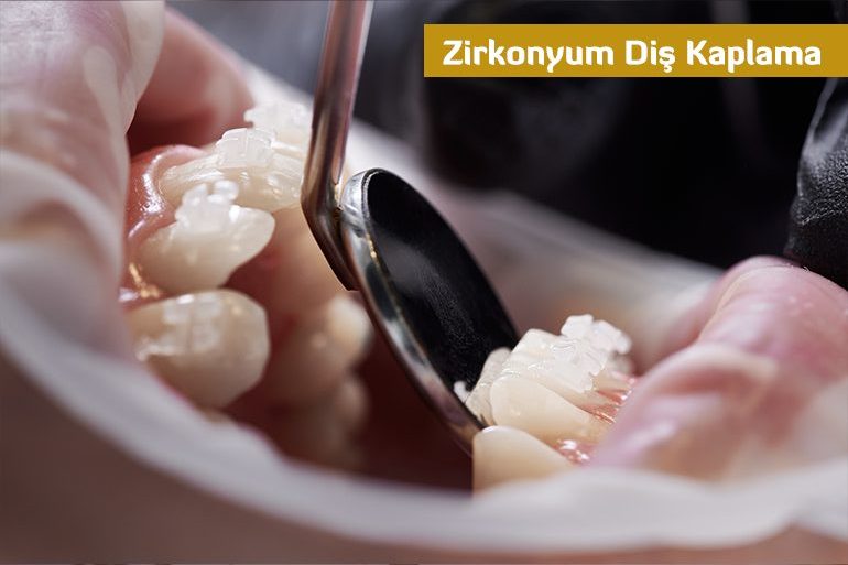 Zirkonyum Diş Kaplama