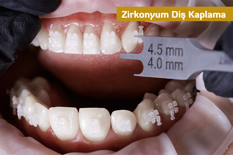 Zirkonyum Diş Kaplama