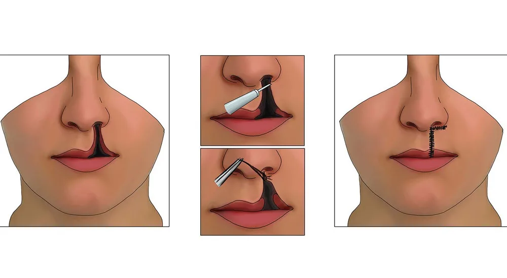 Dudak Damak Yarıkları - Prof. Dr. Hakan Ağır