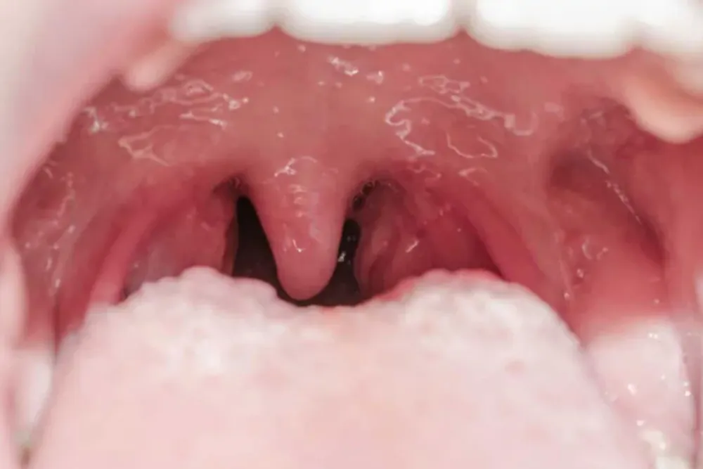 Dudak Damak Yarıkları - Prof. Dr. Hakan Ağır