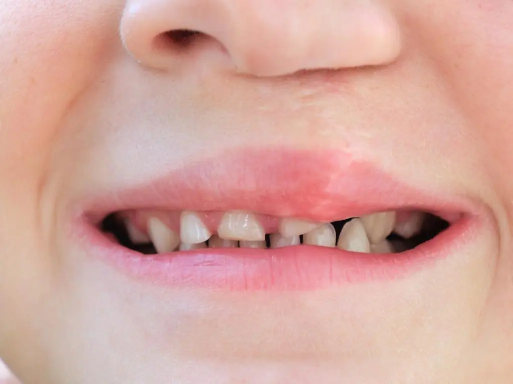 Dudak Damak Yarıkları - Prof. Dr. Hakan Ağır