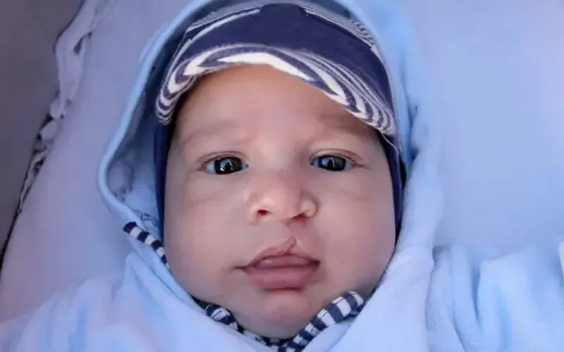 Dudak Damak Yarıkları - Prof. Dr. Hakan Ağır