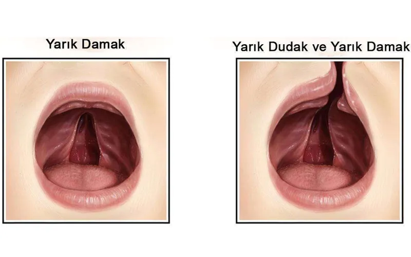 Dudak Damak Yarıkları - Prof. Dr. Hakan Ağır