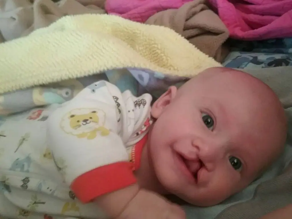 Dudak Damak Yarıkları - Prof. Dr. Hakan Ağır