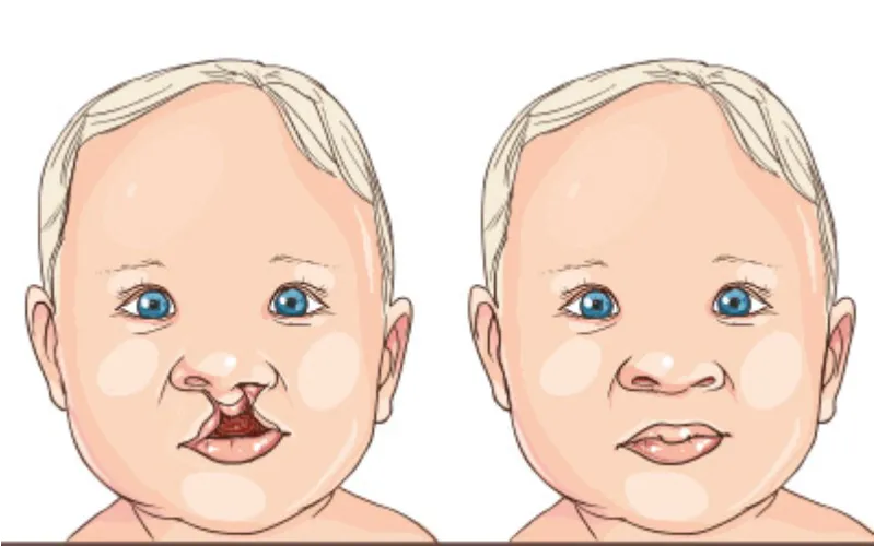 Dudak Damak Yarıkları - Prof. Dr. Hakan Ağır