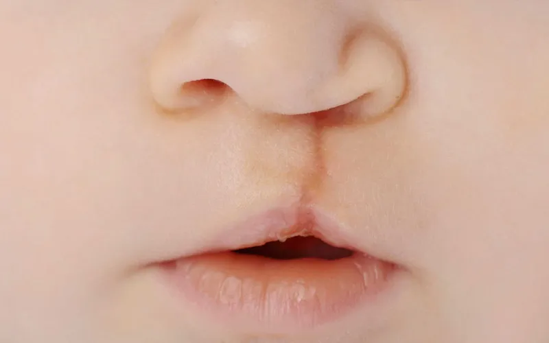 Dudak Damak Yarıkları - Prof. Dr. Hakan Ağır