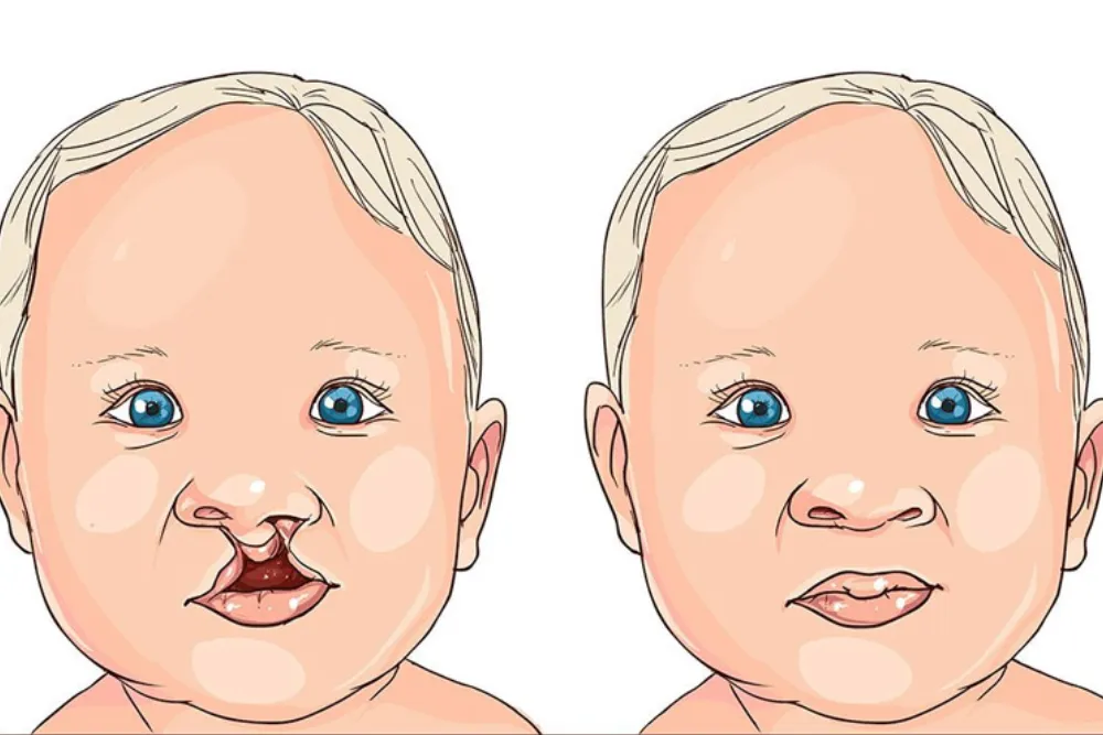 Dudak Damak Yarıkları - Prof. Dr. Hakan Ağır