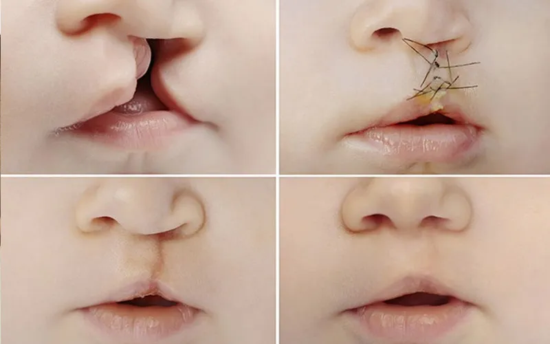 Dudak Damak Yarıkları - Prof. Dr. Hakan Ağır